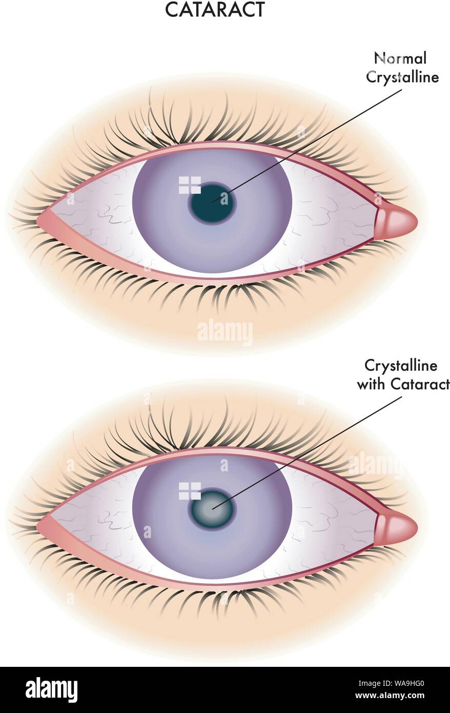 Medizinische Illustration der Auswirkungen der Katarakt. Stock Vektor