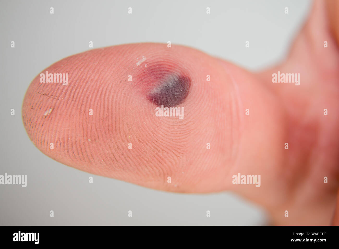 Blutblase unter dem Daumen Haut. Kaukasischen jungen Mann mit dem Finger auf weißem Hintergrund Stockfoto