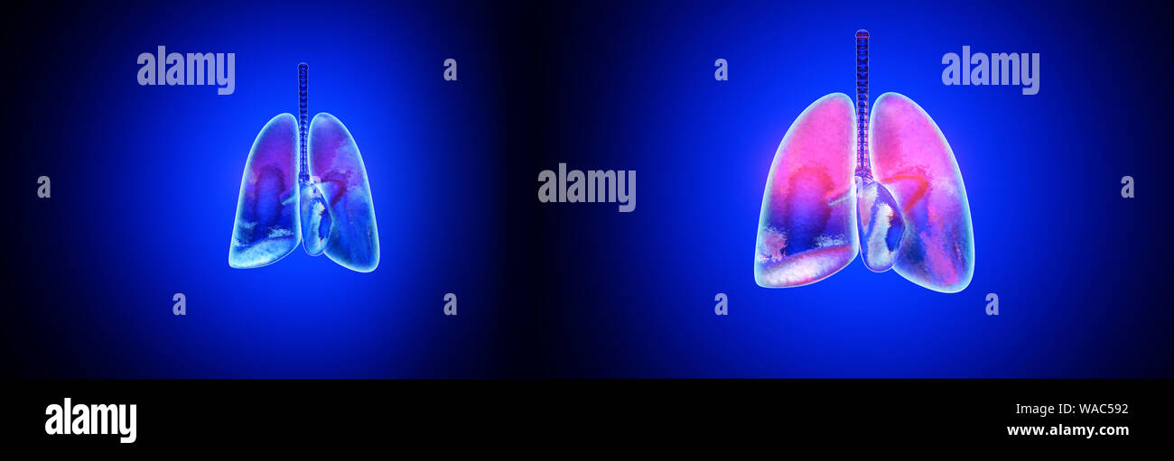 Bronchitis radiography -Fotos und -Bildmaterial in hoher Auflösung – Alamy