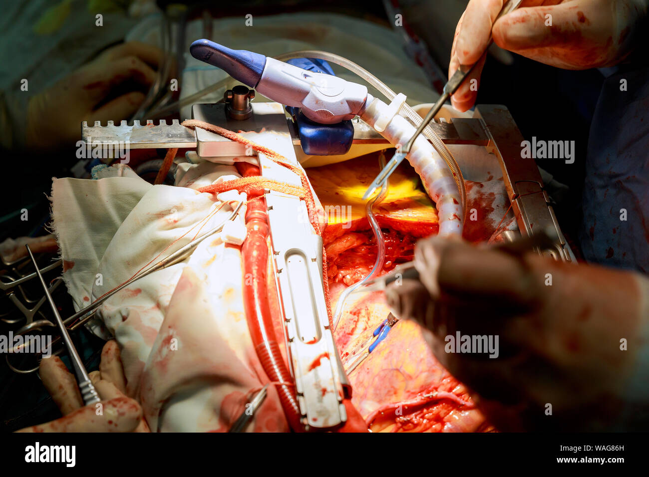 Ein Chirurg führt einer aortokoronaren Bypass Operation am offenen Herzen Arterie Stockfoto