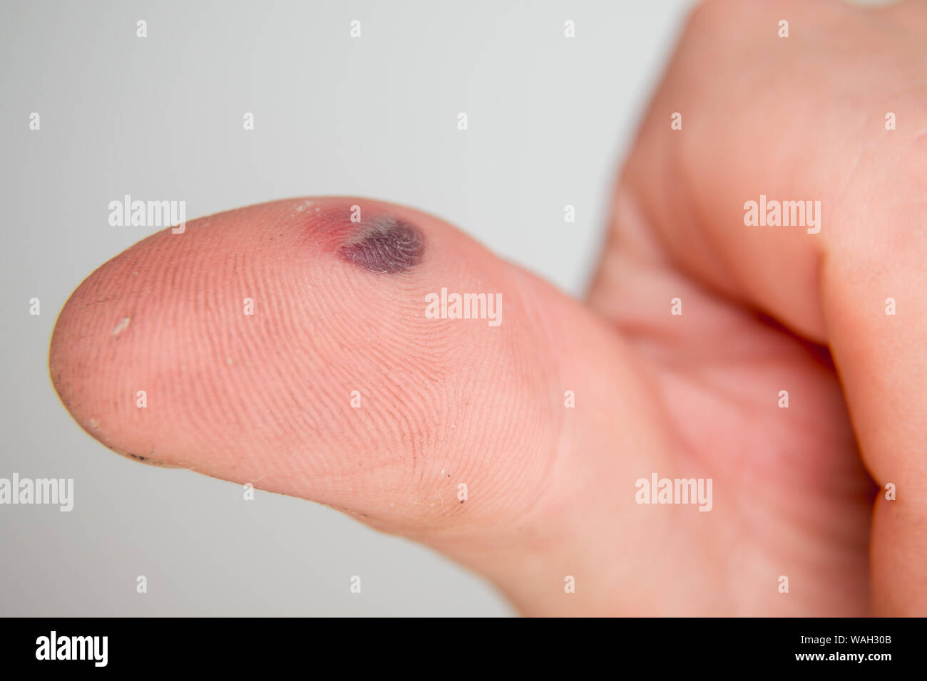 Blutblase unter dem Daumen Haut. Kaukasischen jungen Mann mit dem Finger auf weißem Hintergrund Stockfoto