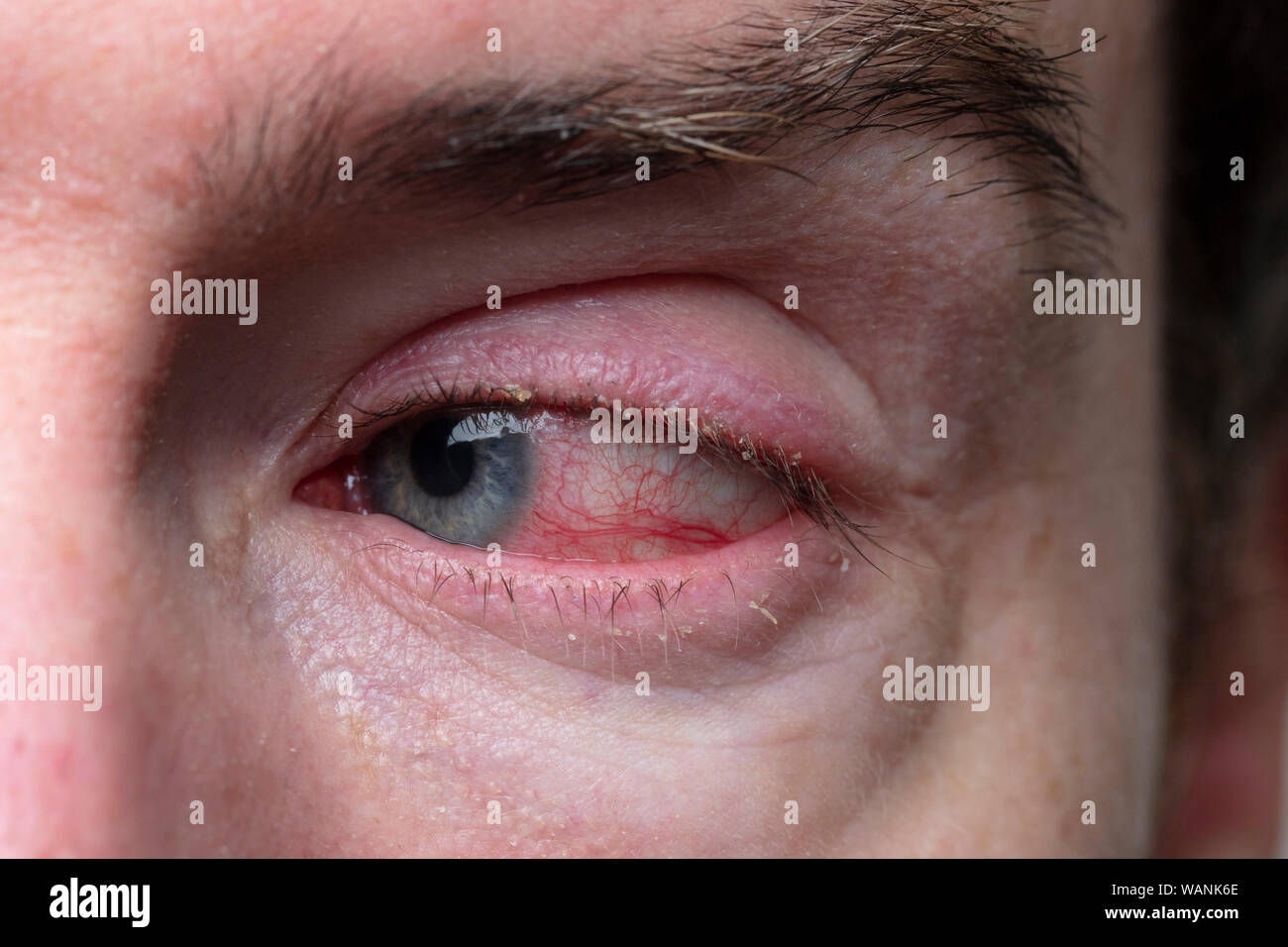 Nahaufnahme von einem schweren blutunterlaufene Auge. Blepharitis, Konjunktivitis Zustand Stockfoto