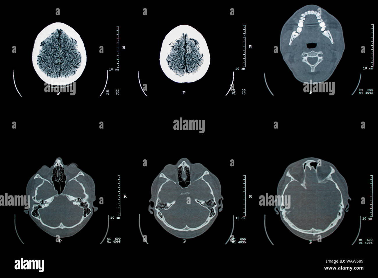 Tomographische Untersuchung Röntgenbild eines menschlichen Kopfes Stockfoto