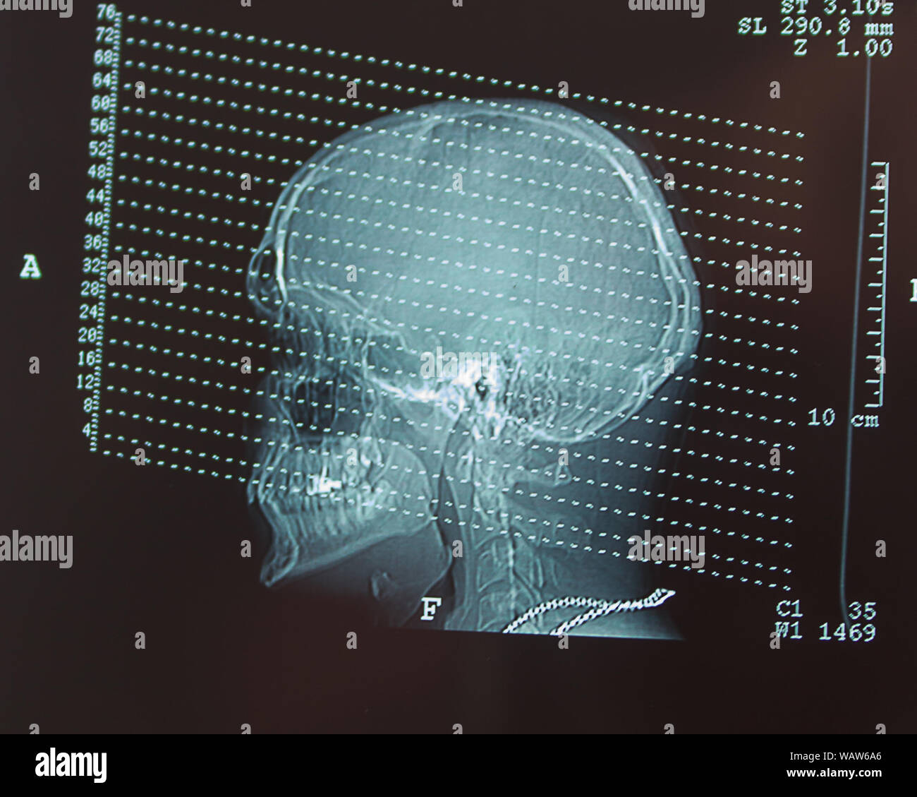 Tomographische Untersuchung Röntgenbild eines menschlichen Kopfes Stockfoto