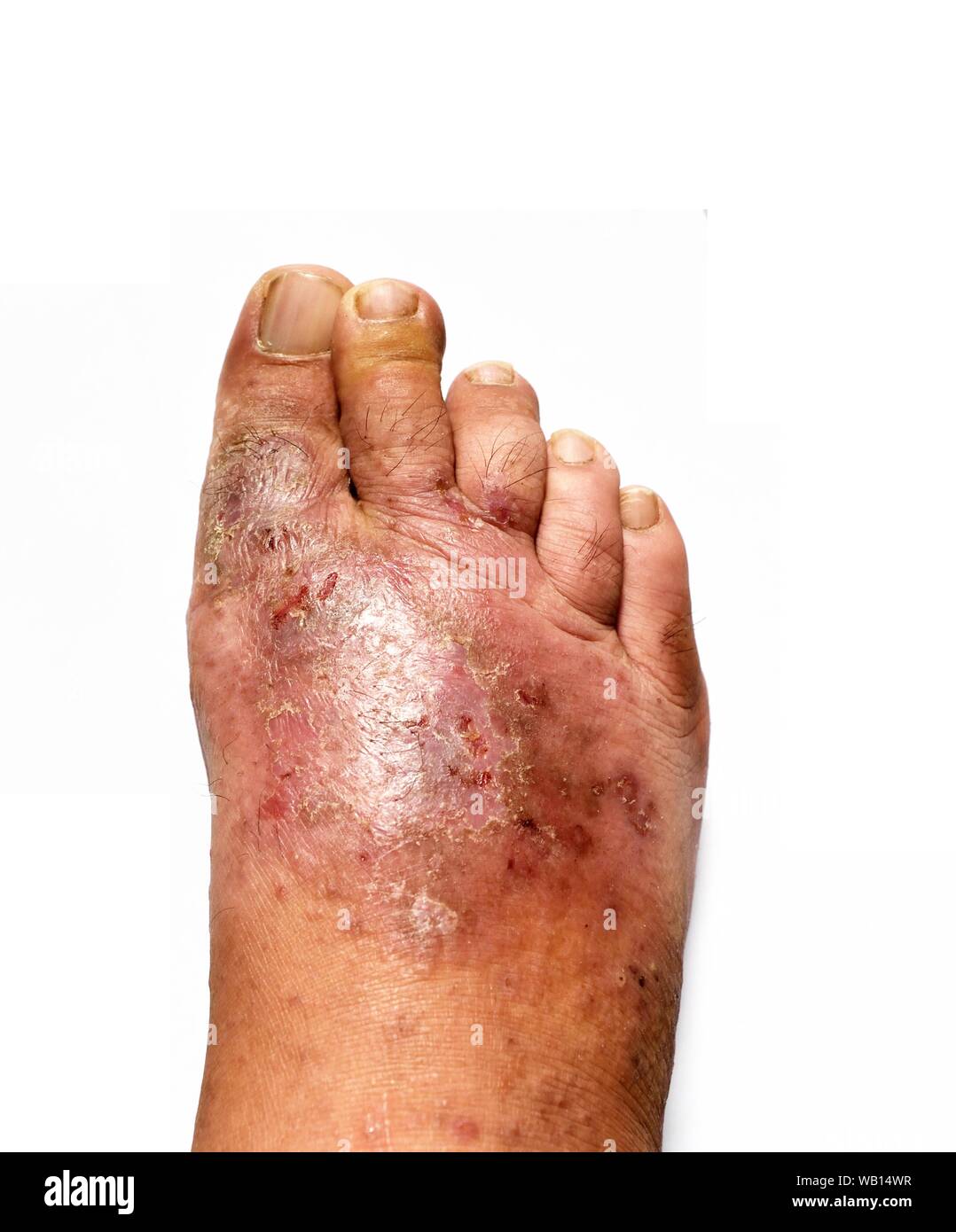 Der menschliche Fuß ist eine Pilzinfektion der Haut Läsionen auf weißem Hintergrund, Fußpilz, Dermatophyten oder Tinea pedis, Candida albicans Stockfoto
