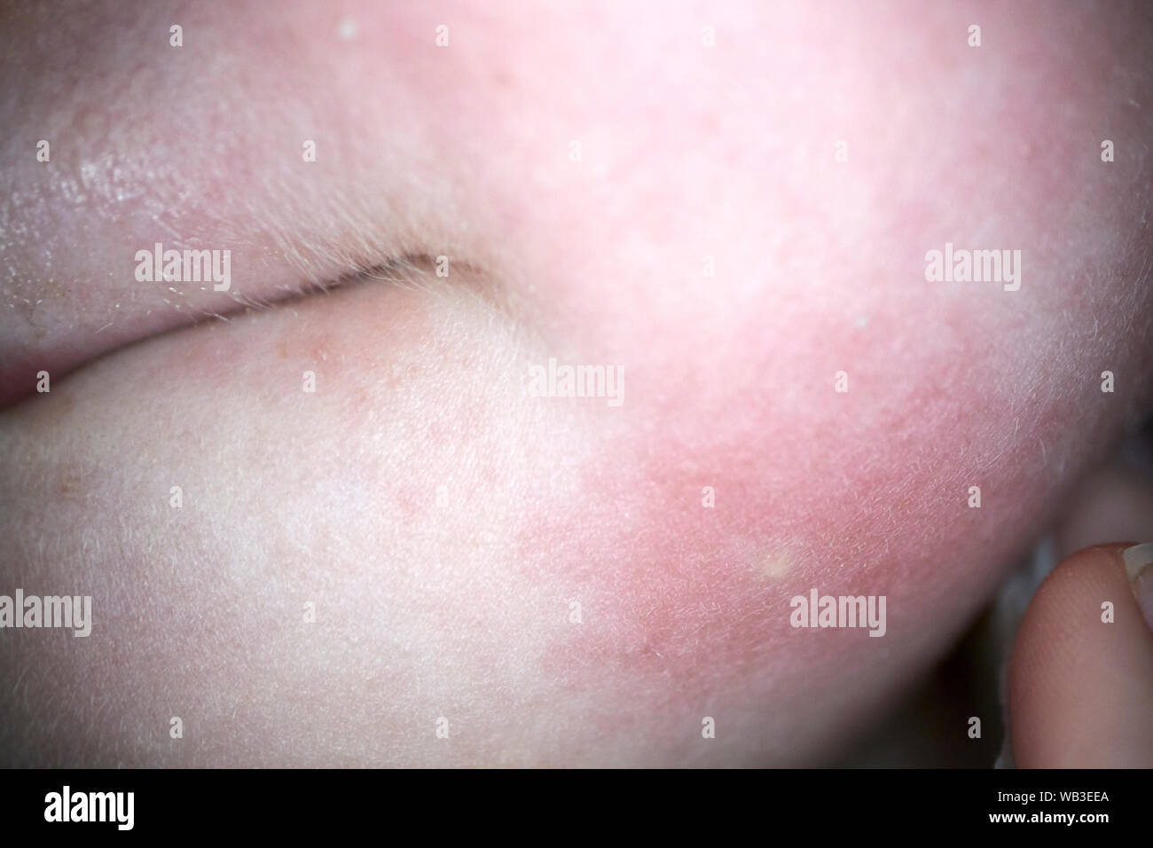 Wespenstich Mark und Entzündung auf dem Gesicht eines fünf Jahre alten Mädchen, England, Großbritannien Stockfoto
