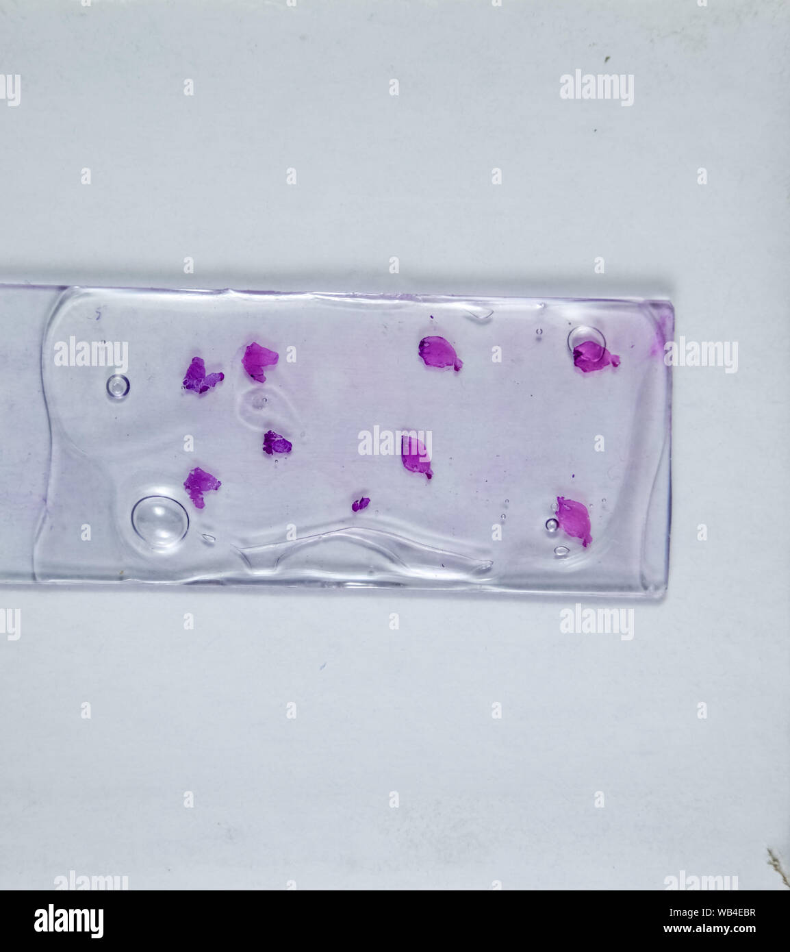 Schichten des Tumors unter Glas. Die histologische Untersuchung der ...