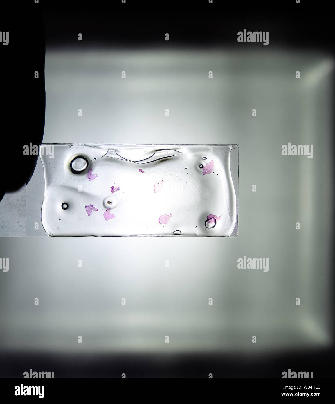 Schichten des Tumors unter Glas. Die histologische Untersuchung der ...