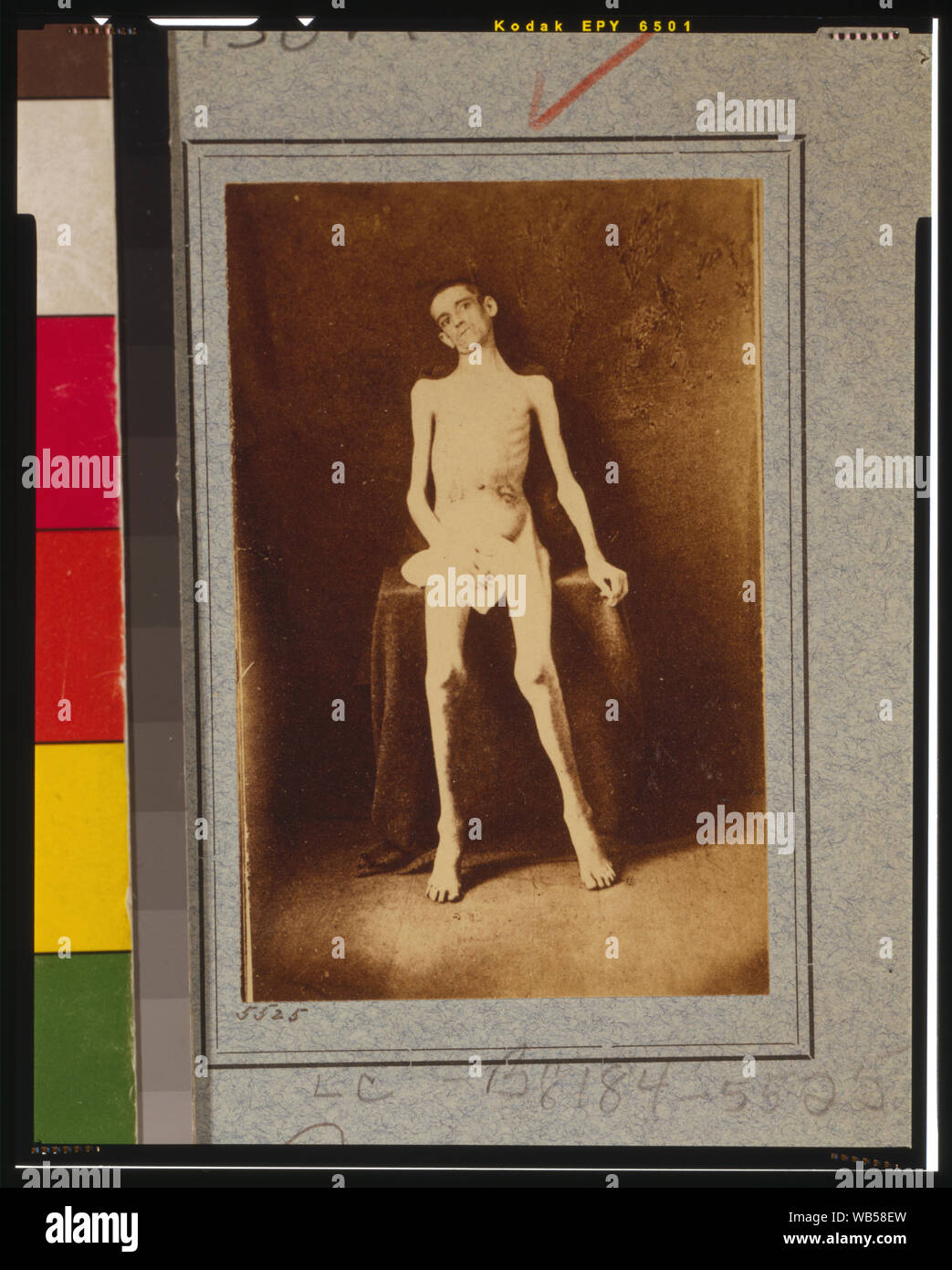 Abgemagert Kriegsgefangenen von Belle Isle, Richmond, Private William M. Smith von Co.D des 8 Kentucky Freiwillige, auf den US-General Hospital, Div. 1, Annapolis Abstract: Foto zeigt Pvt. William M. Smith, Co.D, 8 Bde. Kentucky bei US-General Hospital, Div. Nr. 1, Annapolis, Maryland, 1. Juni 1864. Quelle: U.S. Army Erbe und Education Centre, 2013. Stockfoto