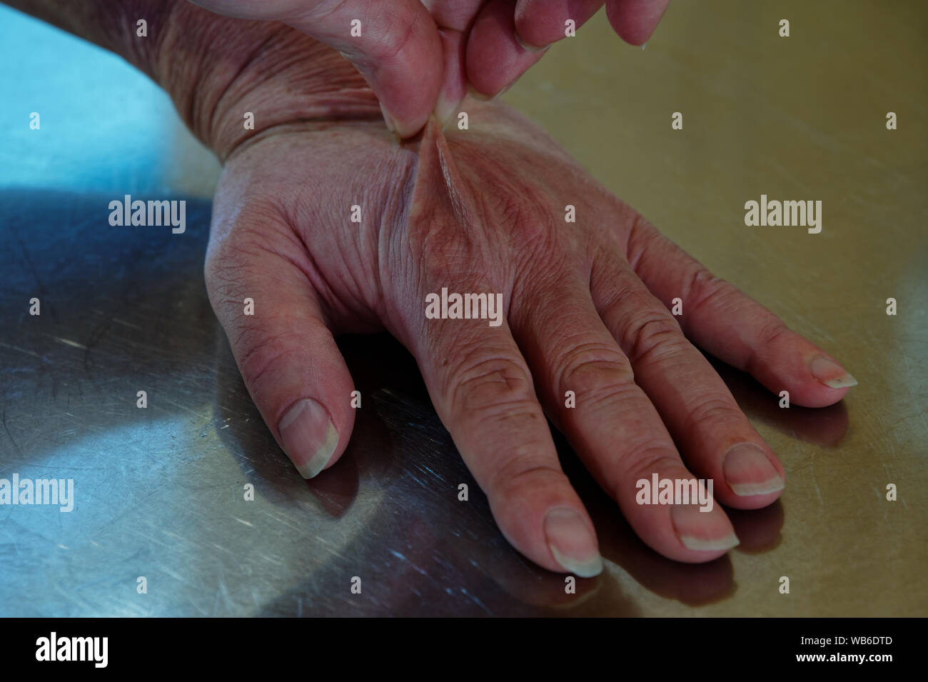 Quetschen die Rückseite einer Hand für Dehydrierung auf einem Edelstahl Tisch zu testen Stockfoto