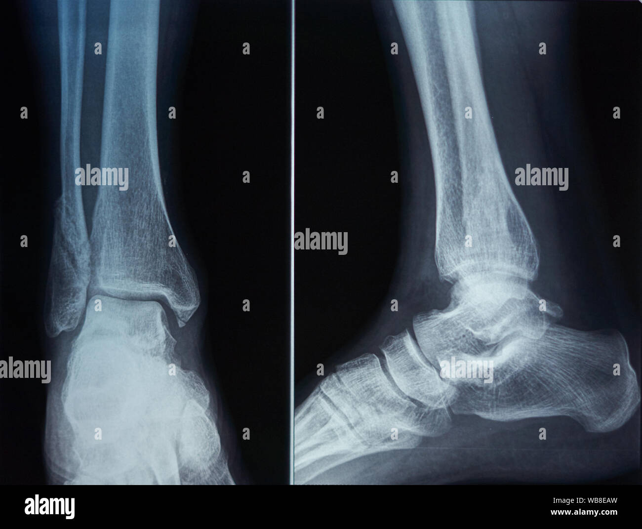 Knochen Scan eines Fuß Stockfoto