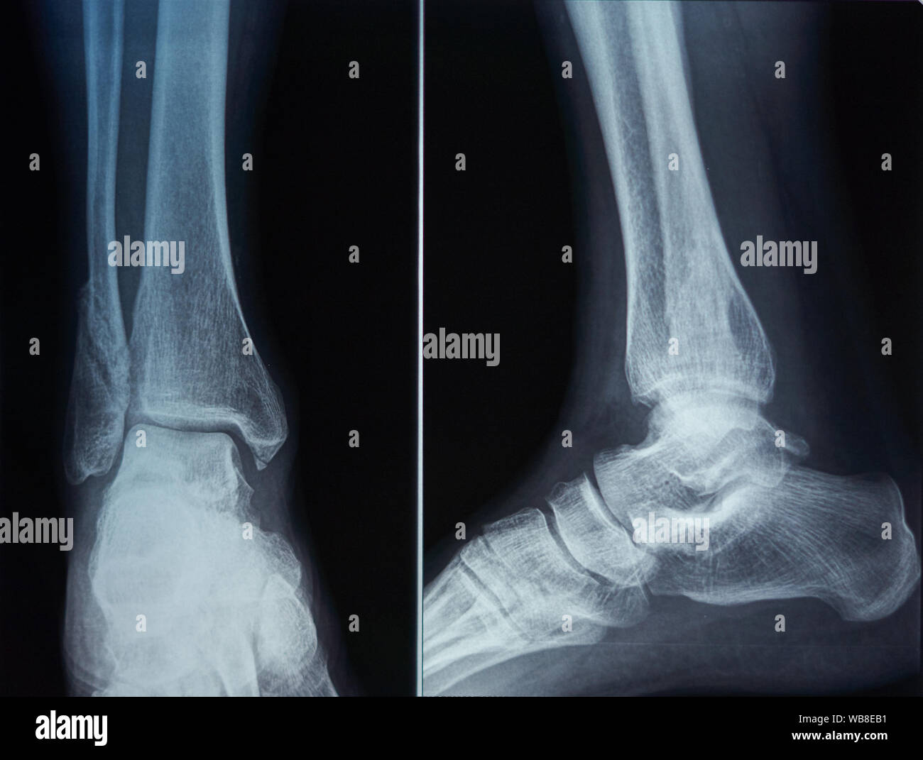 Knochen Scan eines Fuß Stockfoto