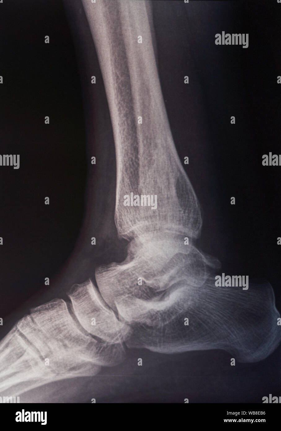 Knochen Scan eines Fuß Stockfoto