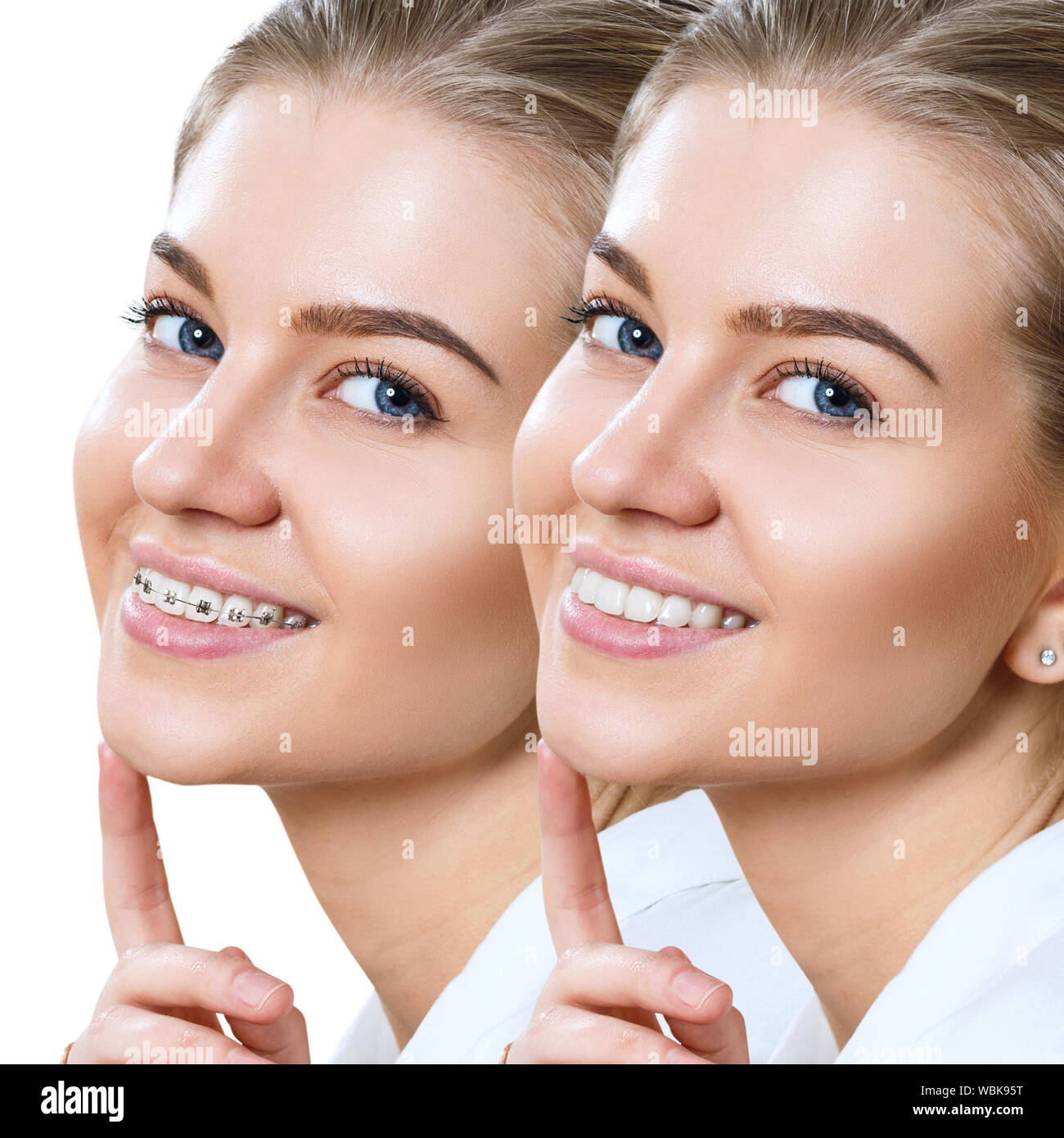 Schöne Frau lächelnd mit perfekte Zähne vor und nach den Klammern. Auf weiß isoliert. Stockfoto