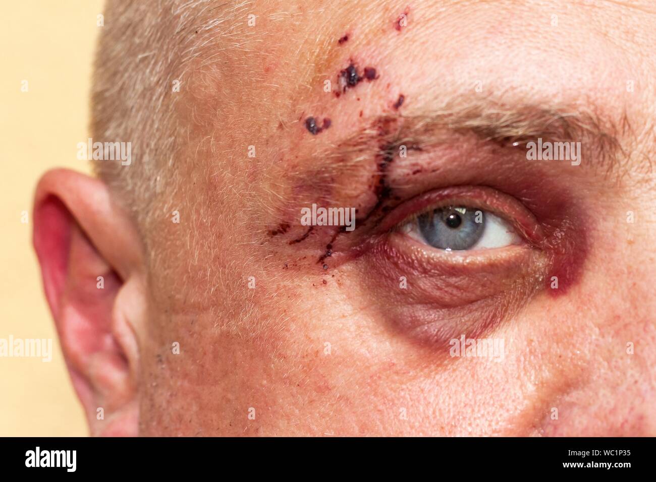 Männliche Auge mit einem großen lila stechen. Bissige Hunde auf dem Gesicht. Augenverletzungen. Große blaue Flecken auf dem männlichen Auge. Die Behandlung der Verletzungen. Boxer Auge. Stockfoto