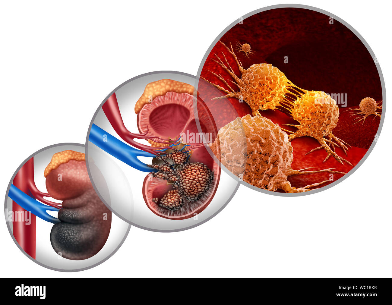 Nierenkrebs Krankheit medizinisches Konzept als bösartige Zellen im menschlichen Körper in Angriff nehmen der Harnwege und der Nieren Karzinom Anatomie als Symbol. Stockfoto