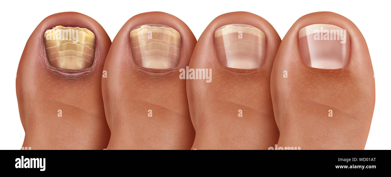 Pilzartige nagelinfektion Recovery Plan und onychomycosisor tinea unguium Behandlung als infizierten Fuß zehennagel oder Toe Nail mit ungesunden beschädigt. Stockfoto