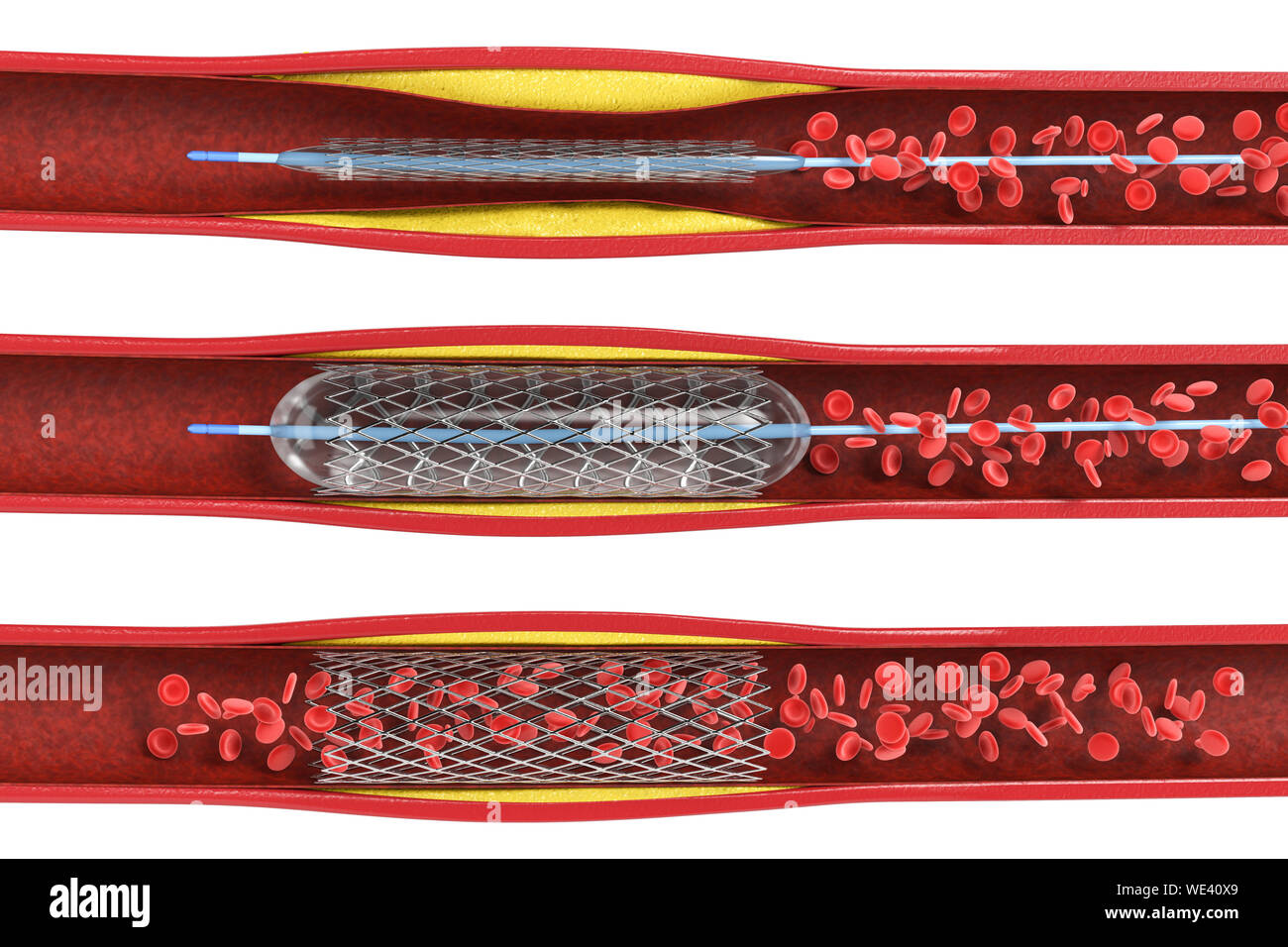 3D-rendering Ballon Angioplastie, Stent in der Vene isoliert auf weißem Stockfoto