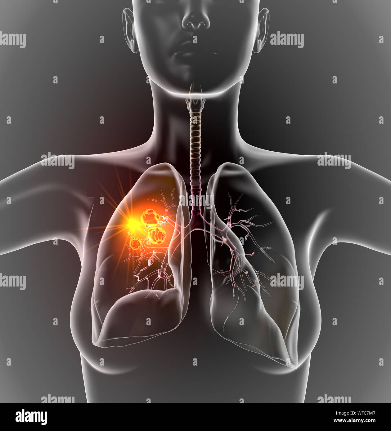 Medizinische Abbildung: Lungenkrebs oder Bronchialkarzinom auf schwarzen Hintergrund, 3D-Darstellung Stockfoto