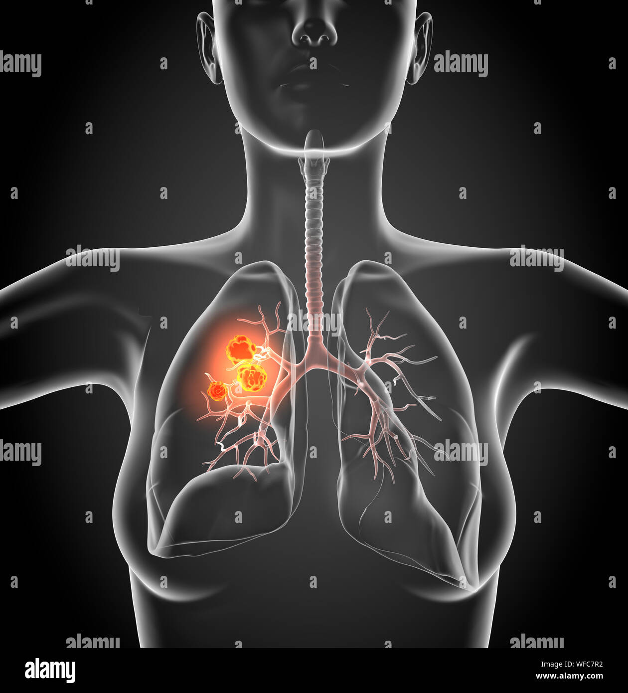 Medizinische Abbildung: Lungenkrebs oder Bronchialkarzinom auf schwarzen Hintergrund, 3D-Darstellung Stockfoto