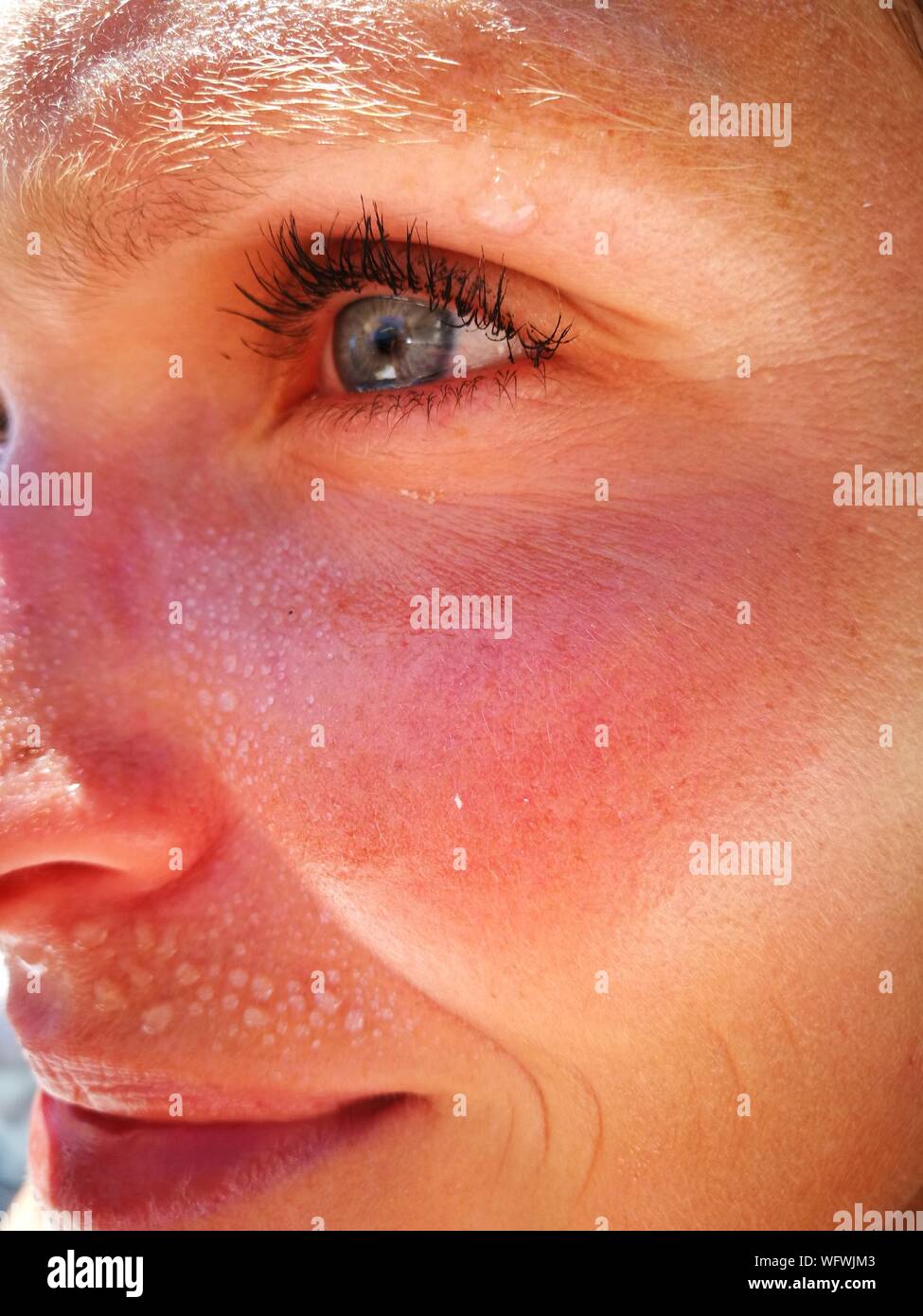 Sonnenbrand gesicht -Fotos und -Bildmaterial in hoher Auflösung – Alamy