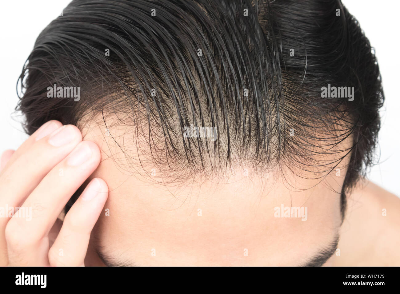 Nahaufnahme der Mann mit Haarausfall Problem vor weißem Hintergrund Stockfoto