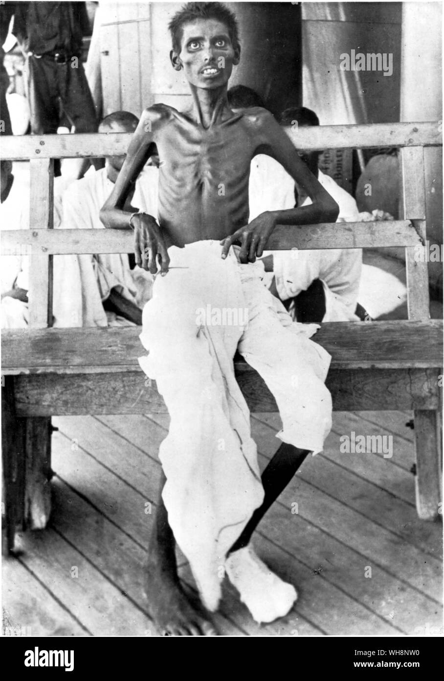 Ein indischer Soldat an Kut gefangen, nach Release unter den Austausch von Gefangenen, die Auswirkungen der Unterernährung Stockfoto