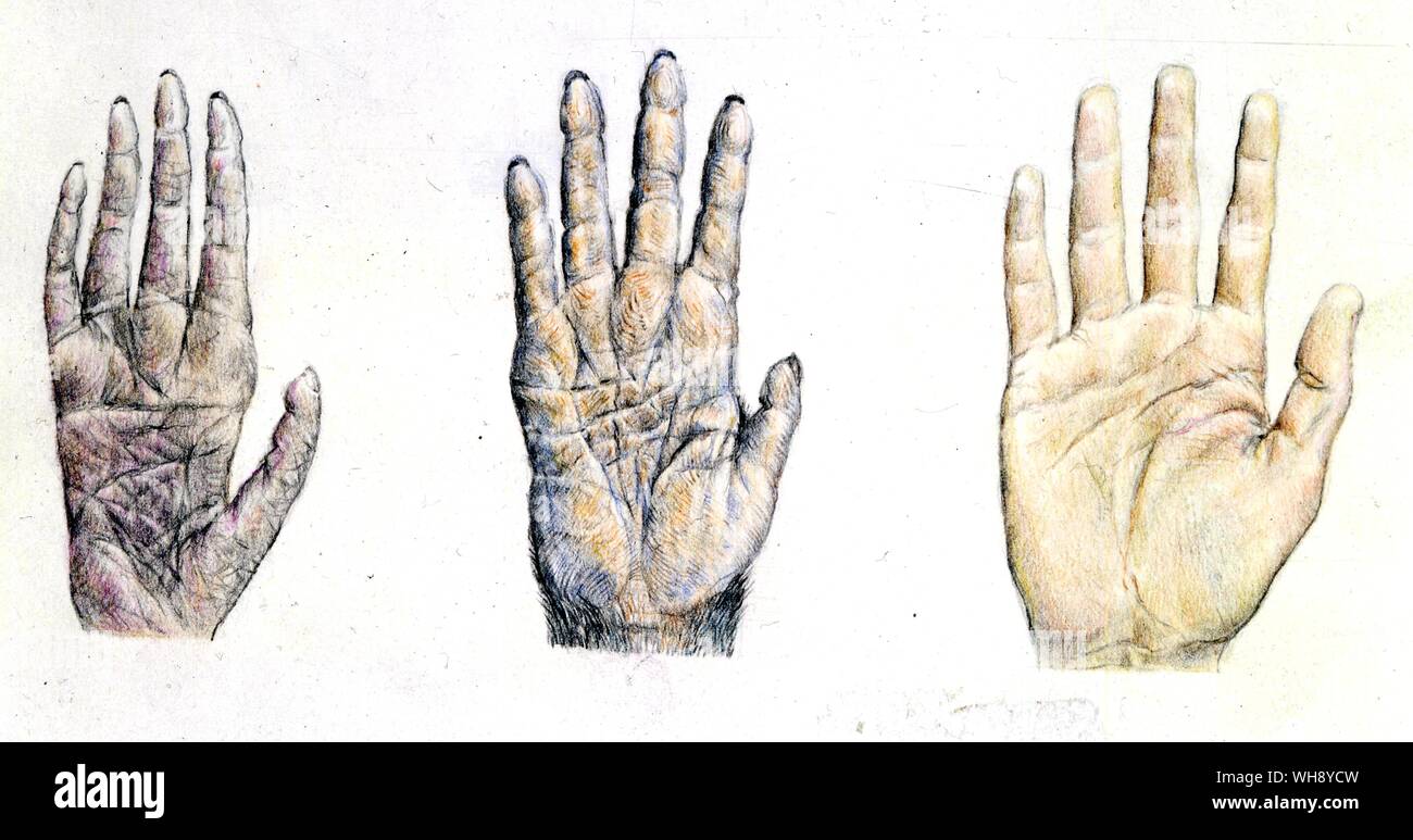 Die Entwicklung unserer Hände und die manipulativen Fähigkeiten, die entwickelt wurden, sind wichtige Faktoren bei der Entwicklung unserer Gehirne und Vice wurde umgekehrt. Die Hände von Gibbon und Schimpanse und Homo vergleichen Stockfoto