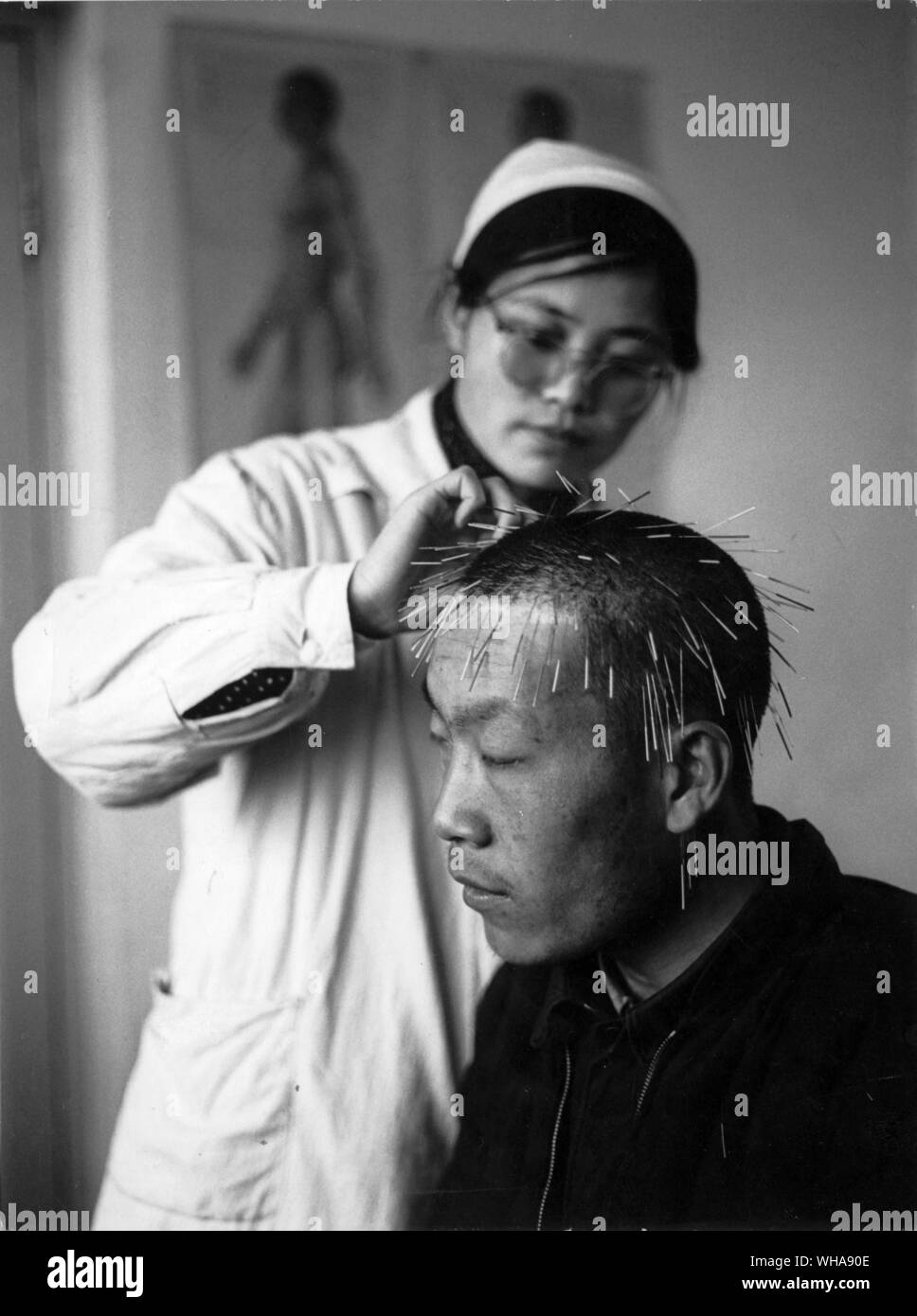 Akupunktur. China Peking. Akupunktur in der Tseng ich Yen Krankenhaus der Traditionellen Medizin. Stockfoto