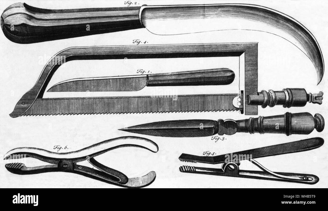 Chirurgische Instrumente: Amputation Instrumente. Erste Hälfte des 18. Jahrhunderts Stockfoto