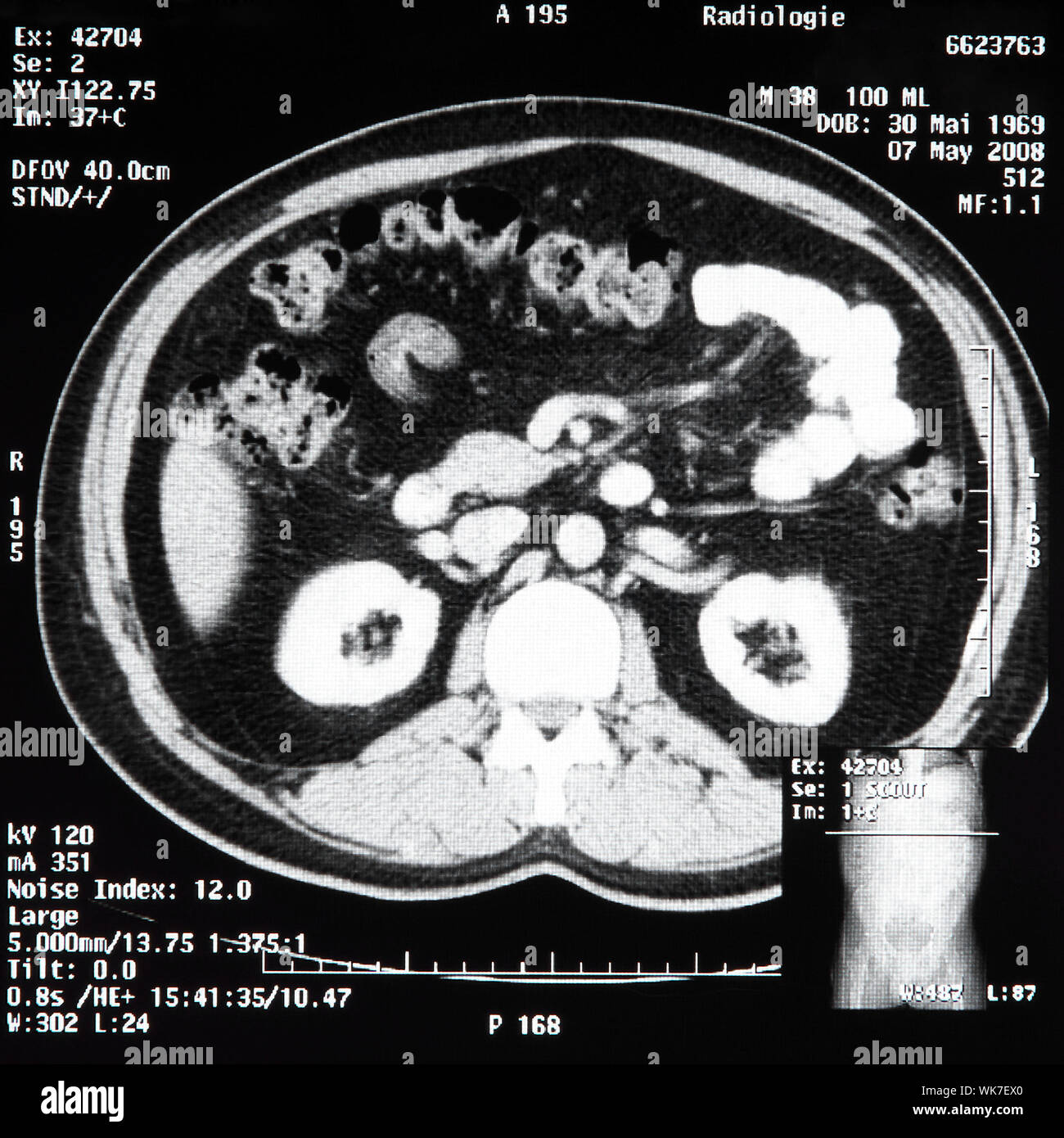 Ct scan abdomen -Fotos und -Bildmaterial in hoher Auflösung – Alamy
