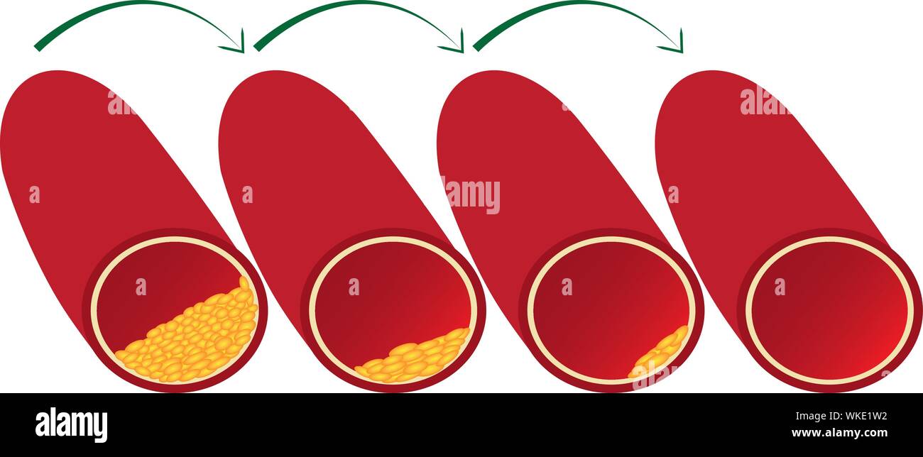 Clean-up und redusing Gefäß Blut von atherosklerotischen Plaque Vector Illustration Stock Vektor