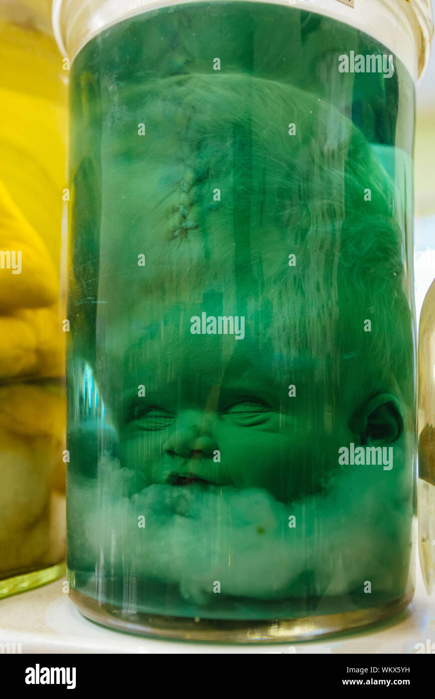 Hydrocephalus Baby Kopf In Glas Mit Formalin Losung Stockfotografie Alamy