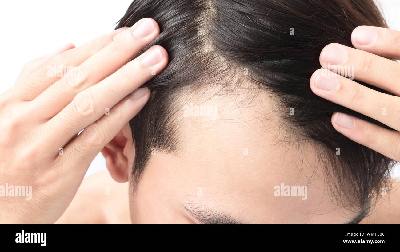 Hohe Abschnitt der Mann mit Haarausfall Problem Stockfoto