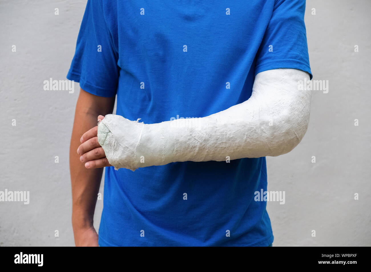 Mann mit gebrochenen Arm gewickelt Medizinische cast Gips. Fiberglas cast für das Handgelenk, Arm, Ellenbogen nach Sport Unfall, isoliert auf weißem Stockfoto