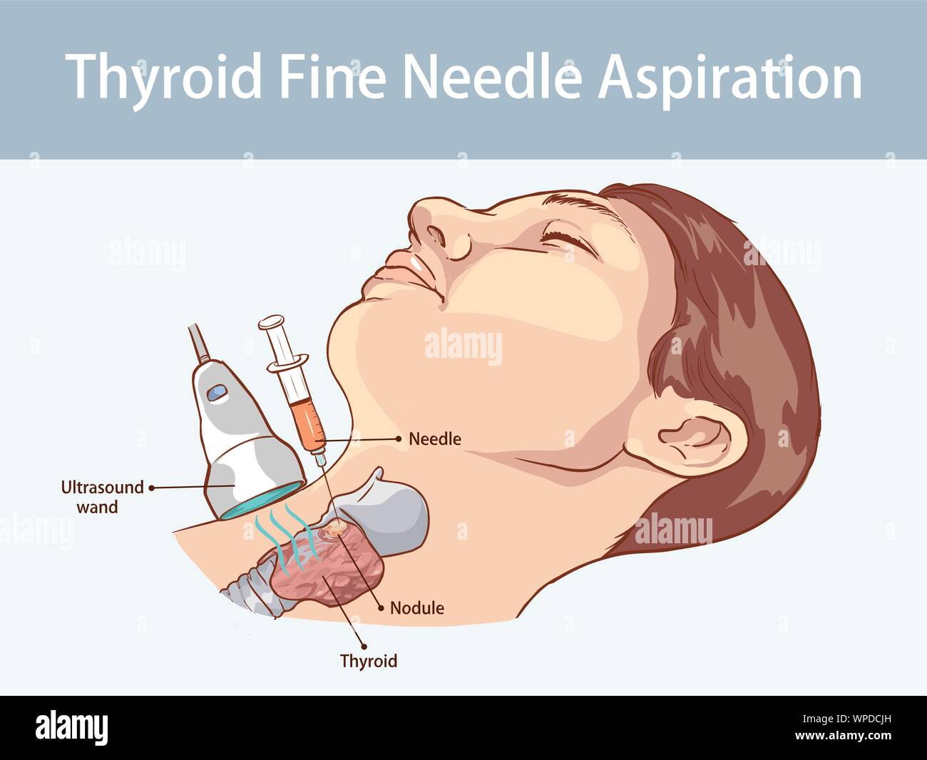 Feine Nadelaspiration von Knoten in der Schilddrüse Stock Vektor