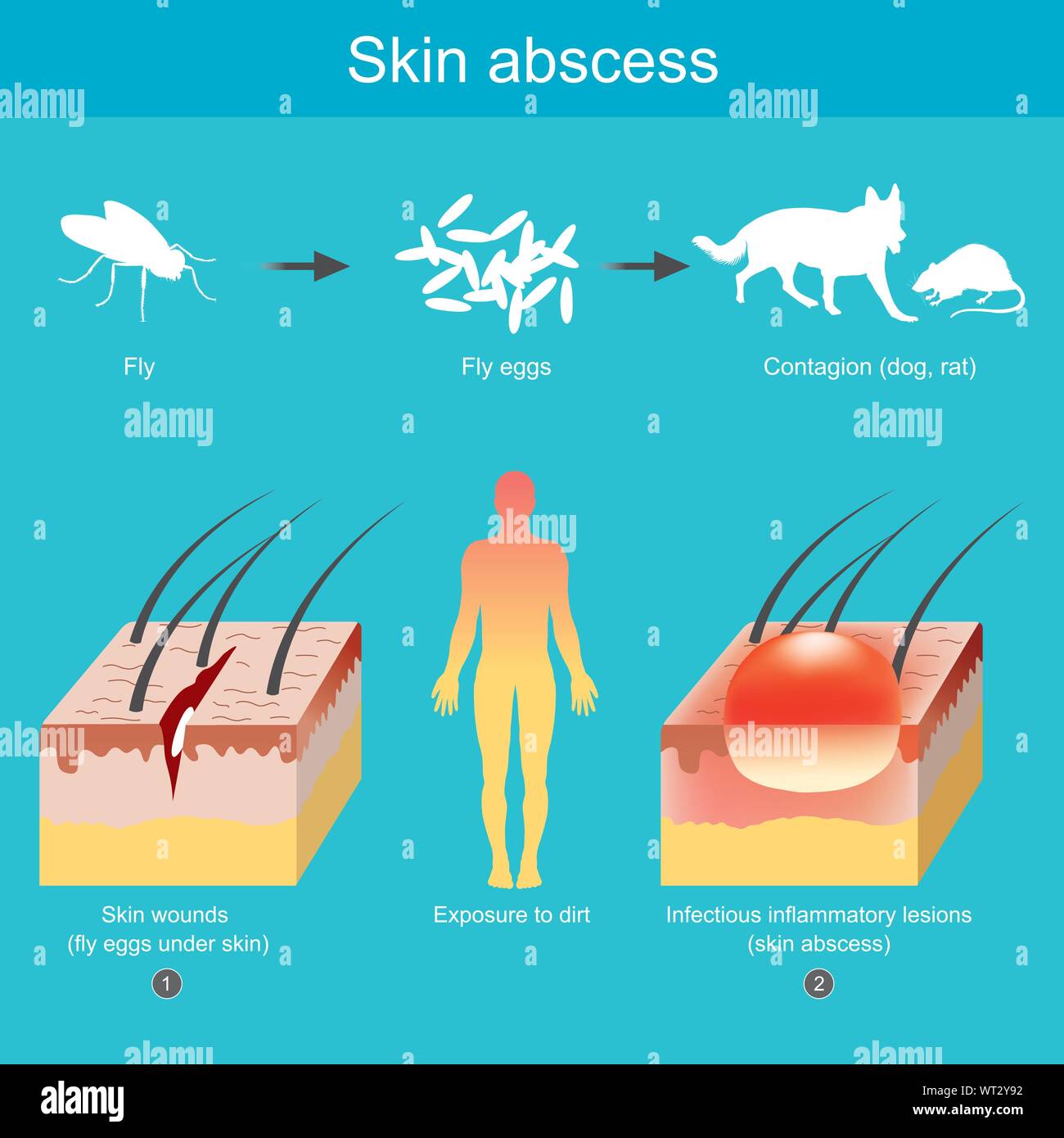 Entzündung der Haut, die durch Krankheitserreger der Eingabe offenen Hautwunden. Stock Vektor