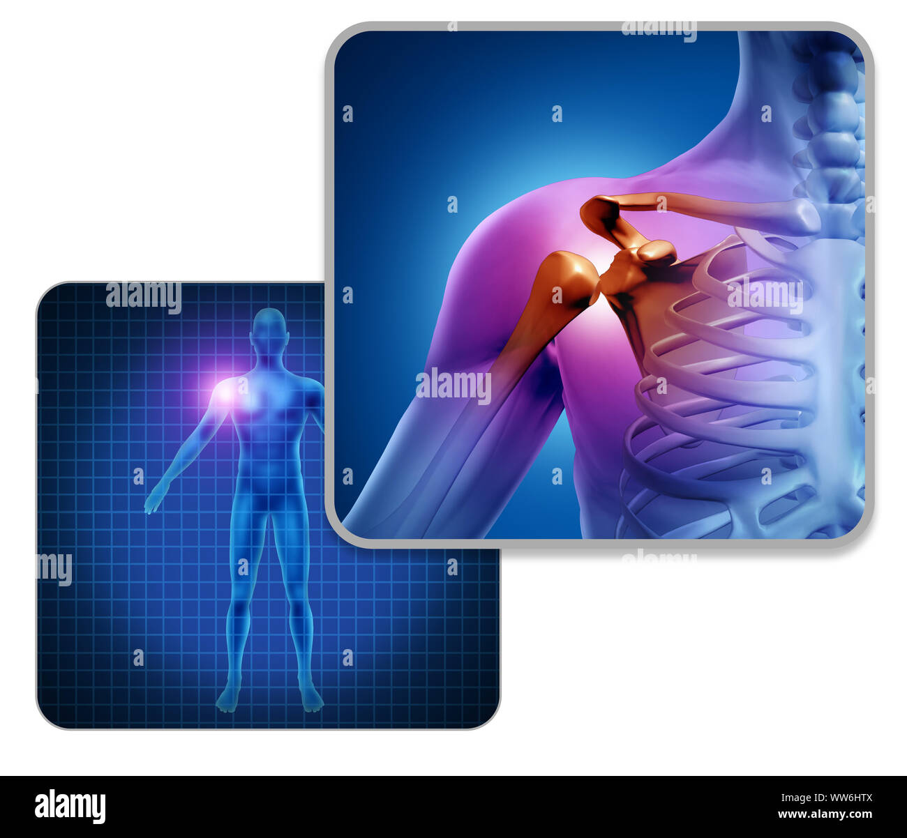Menschliche Schultergelenk schmerzen Konzept als Skelett und Muskel Anatomie des Körpers mit Halsschmerzen Entzündung als eine schmerzhafte Verletzung oder Arthritis Krankheit Symbol. Stockfoto