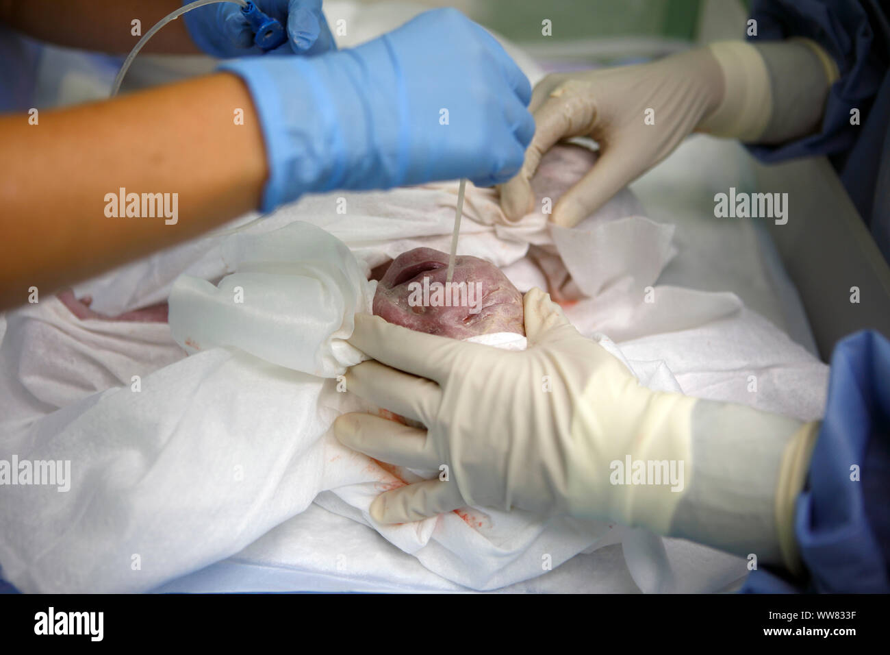 Neugeborene, Ärzte, Operation, Geburt, Kaiserschnitt, Chirurgie, Gesundheitswesen, Krankenhaus, Tschechien Stockfoto