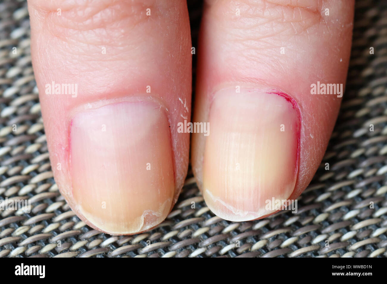 Trockene Haut mit brüchigem Splitten und Peeling Nägel vom Beißen  Stockfotografie - Alamy