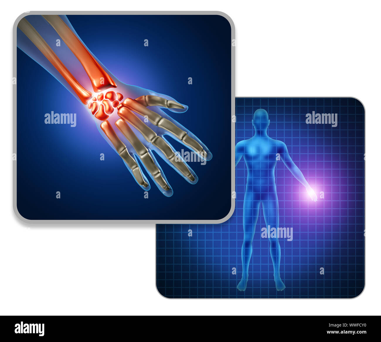 Menschliche Hand Gelenkschmerzen Konzept als Skelett und Muskel Anatomie des Körpers mit einer Gruppe von Wunden Handgelenk- und Fingergelenke als eine schmerzhafte Verletzung. Stockfoto