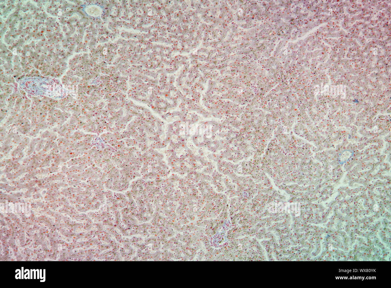Hemosiderosis der Leber gewebe unter dem Mikroskop 100x Stockfoto