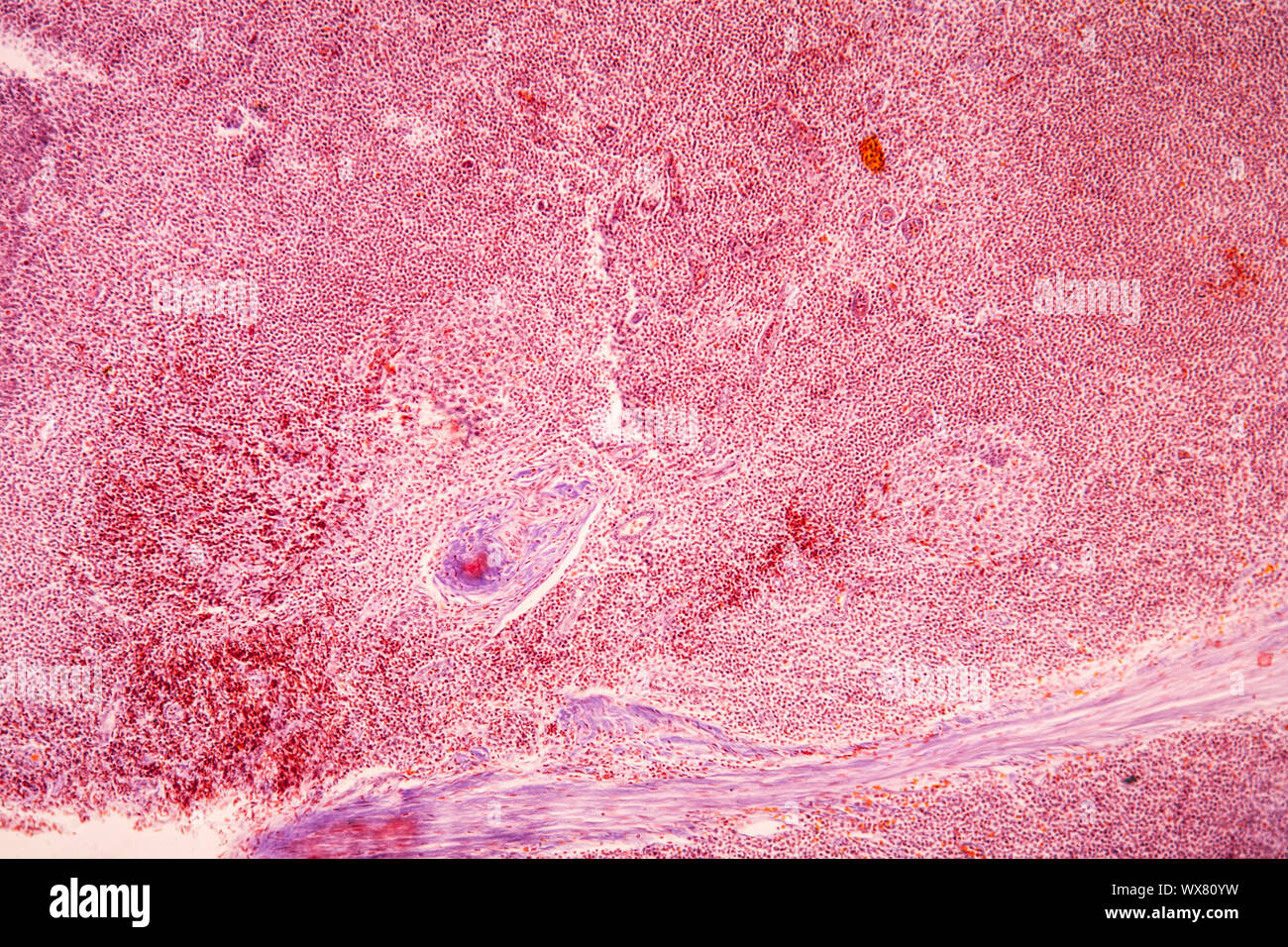 Mandelentzündung krankes Gewebe unter dem Mikroskop 100x Stockfoto