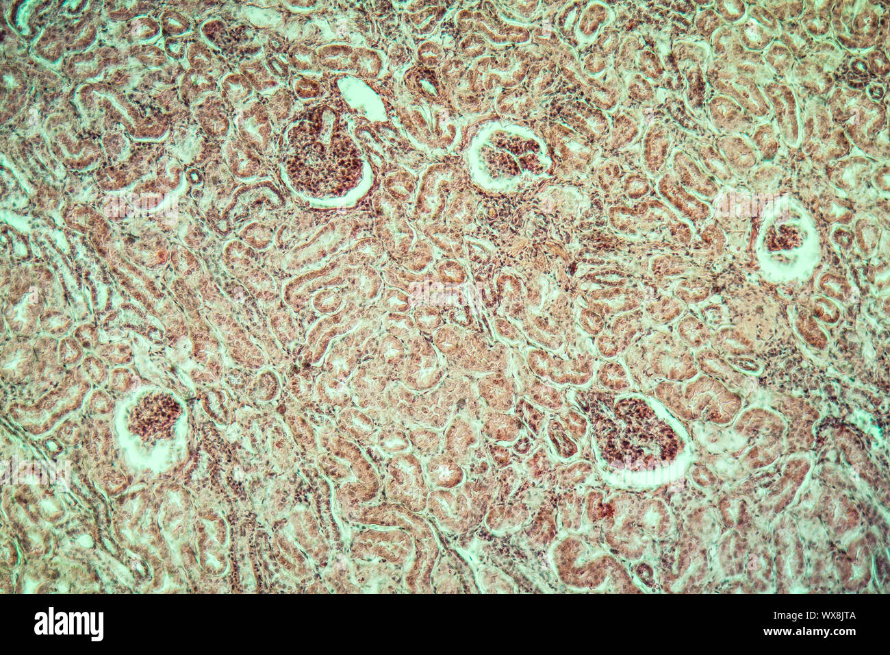 Tuberkulose Niere erkrankte Gewebe 100x Stockfoto