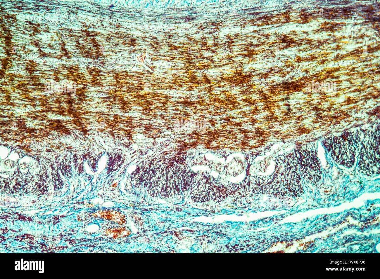 Colitis in der Dysenterie erkrankte Gewebe 100x Stockfoto
