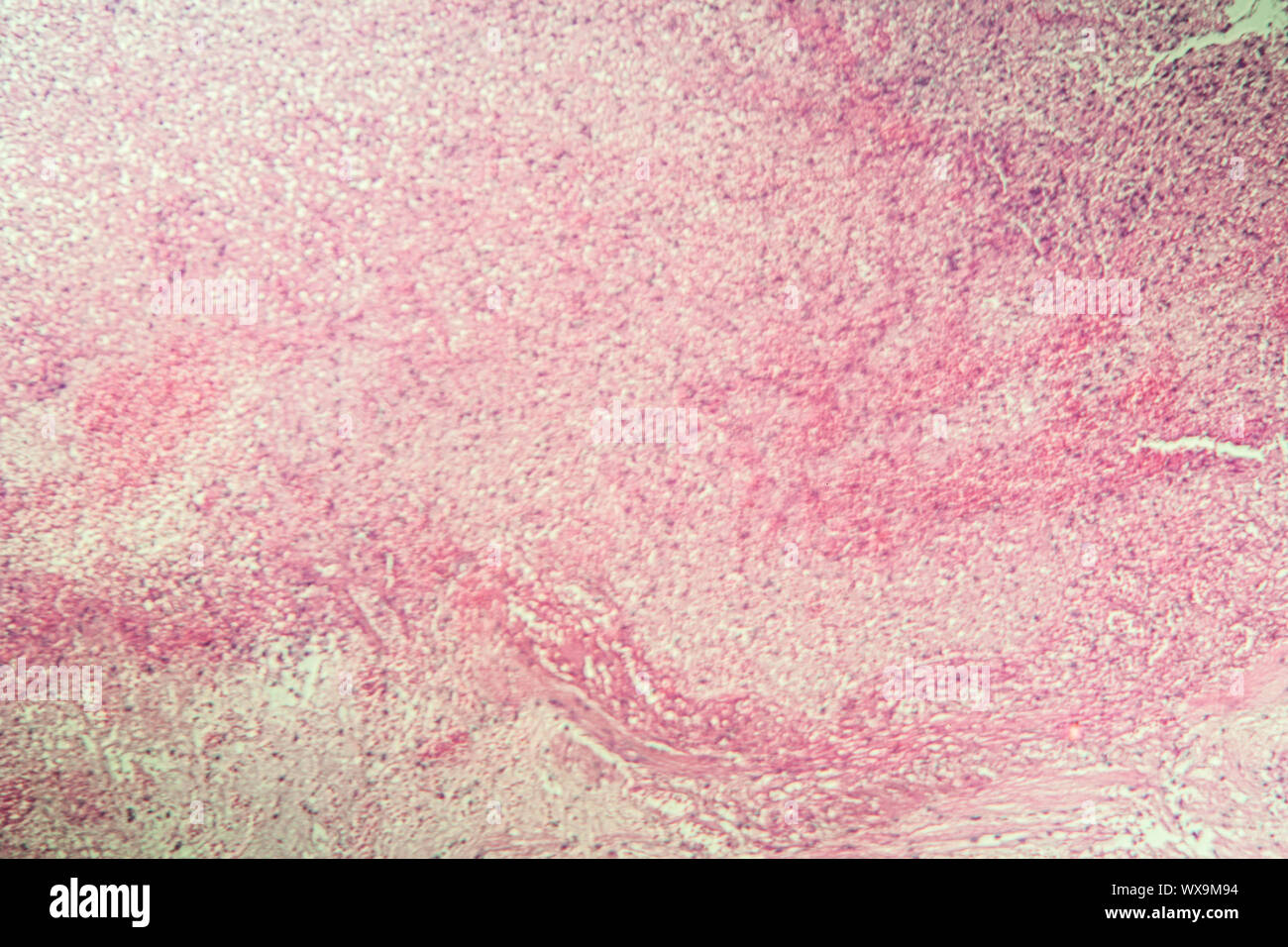 Gallenblase Nekrose Gewebe unter dem Mikroskop 100x Stockfoto