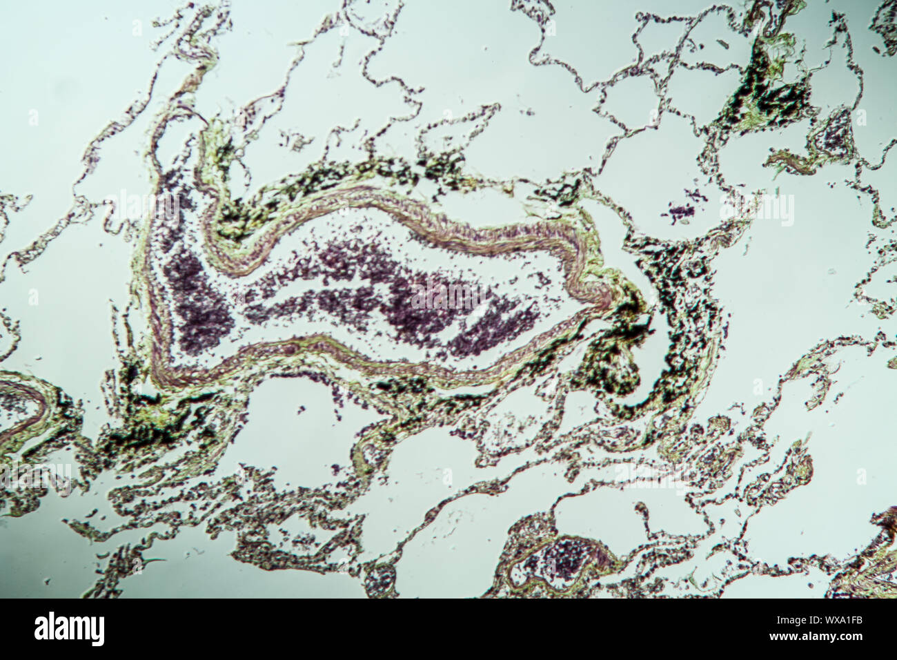 Lunge menschliches Gewebe unter dem Mikroskop 100x Stockfoto