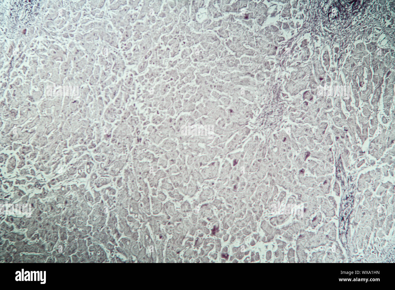 Leber mit Hepatitis Marker krankes Gewebe unter dem Mikroskop 100x Stockfoto