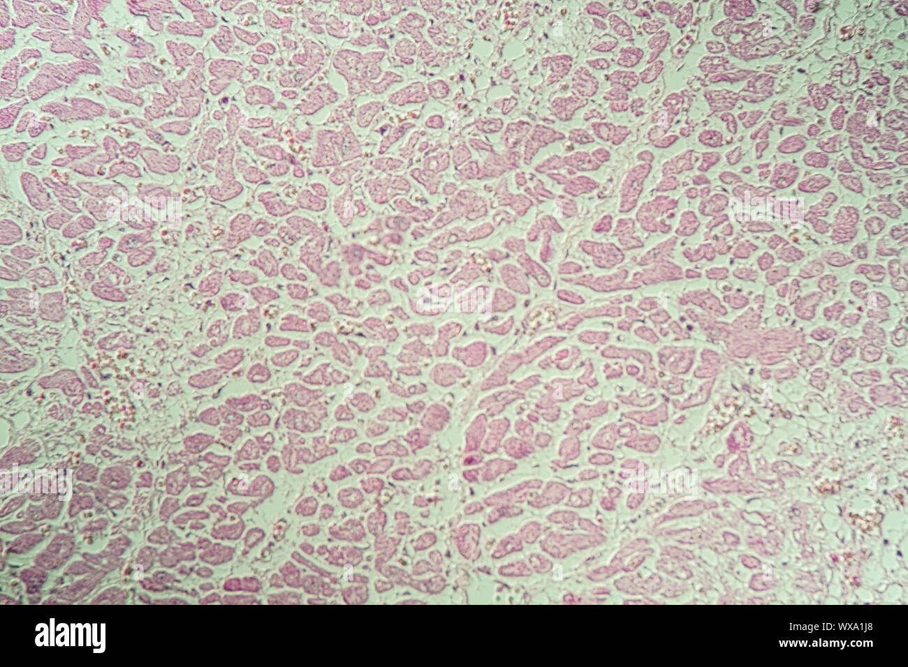 Myokardinfarkt von erkranktem Gewebe unter dem Mikroskop 200x Stockfoto