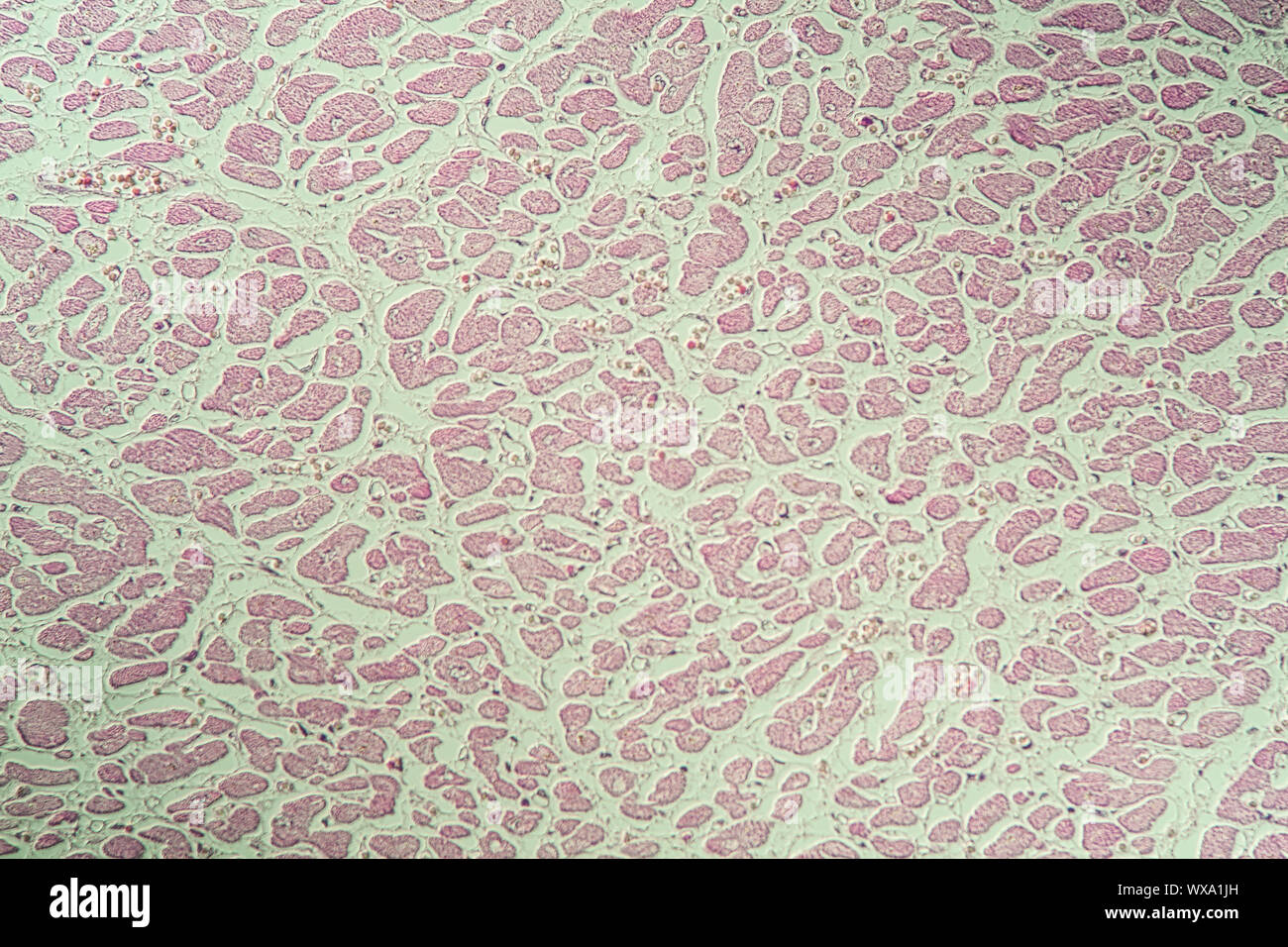 Myokardinfarkt von erkranktem Gewebe unter dem Mikroskop 200x Stockfoto